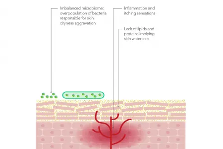 Role of skin microbiome in atopic dermatitis